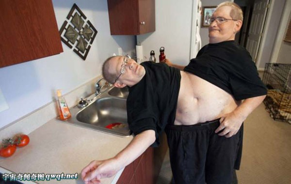 世界上最大的连体婴儿,世界最长寿连体人63岁,连体婴儿分离后样子