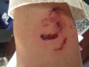 子被狗咬伤变性饥渴,一女子私处被毒蛇咬伤,狗