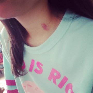 吻痕怎么一天快速消除 吻痕是什么怎么弄出来