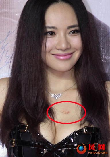 吻痕怎么一天快速消除吻痕是什么怎么弄出来的