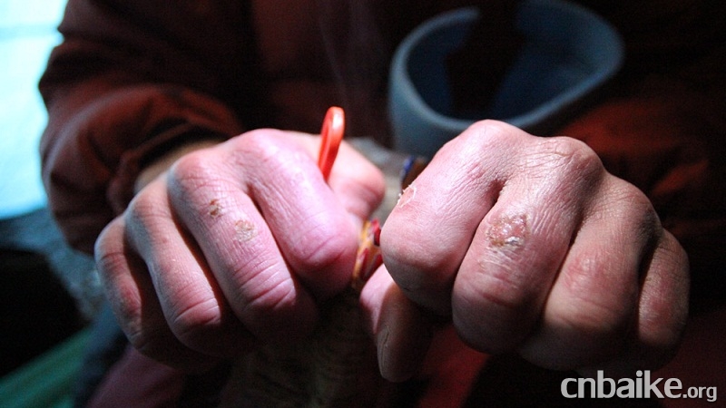 治疗冻疮最好最有效的办法 冻疮疤痕怎么消除