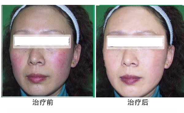 红血丝形成原因怎么消除小偏方 红血丝根治方