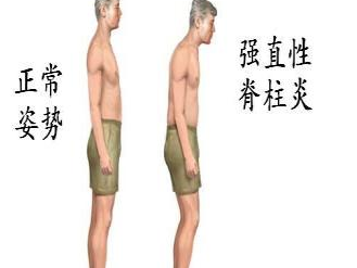 周杰伦的病能活多久能治吗 周杰伦脊椎炎怎么治疗最近情况如何