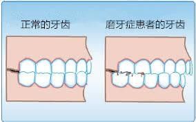 睡觉磨牙是什么原因 夜晚磨牙怎么治磨牙偏方咬橘子皮有效果吗