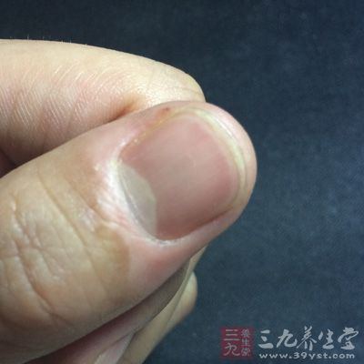 指甲上白点是怎么回事原因 手指甲上有白点怎么治吃什么揭秘