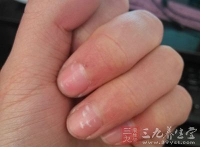 指甲上白点是怎么回事原因 手指甲上有白点怎么治吃什么揭秘