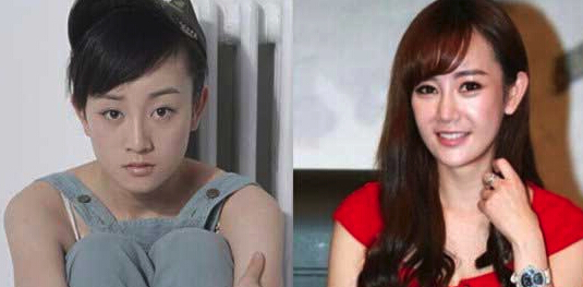 张檬整容前后照片对比太吓人张檬承认整容失败取出假体后的照片