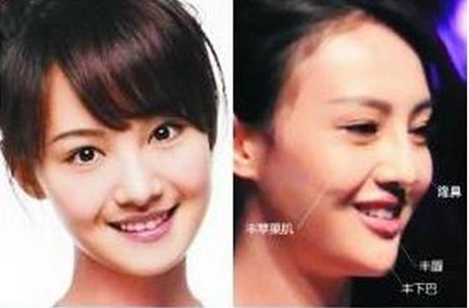 郑爽整容疤痕明显照片对比曝光 杨洋郑爽公开恋情机场吻照流出
