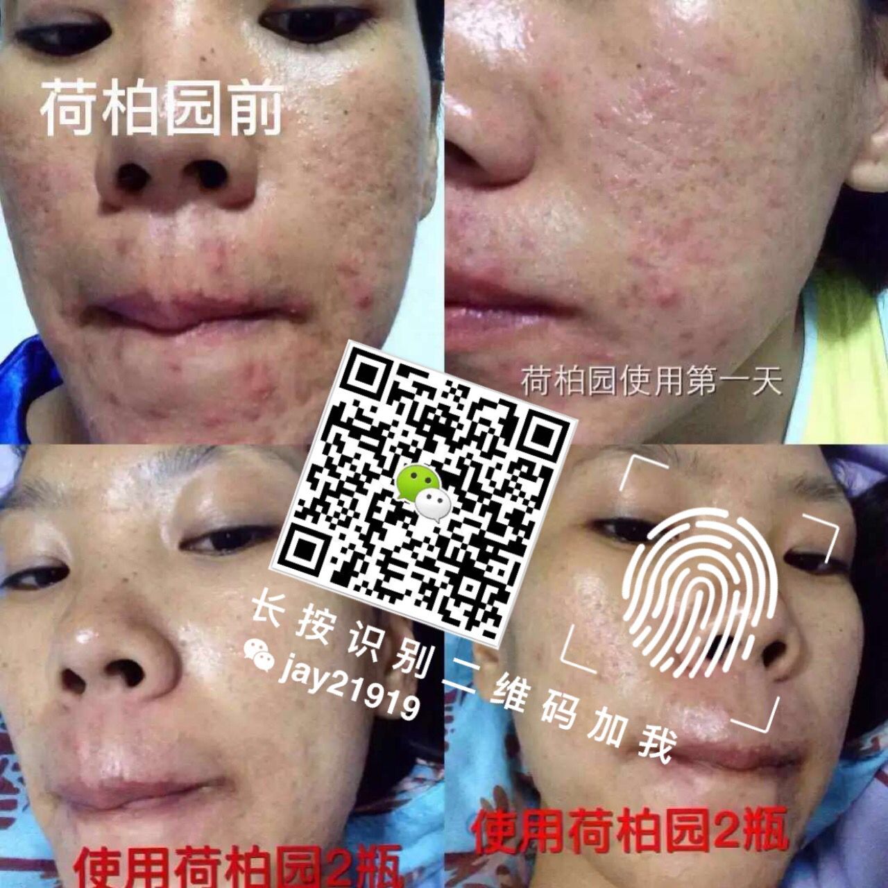 油性痘痘肌肤的清爽4步骤,2015最好用的祛痘产品推荐