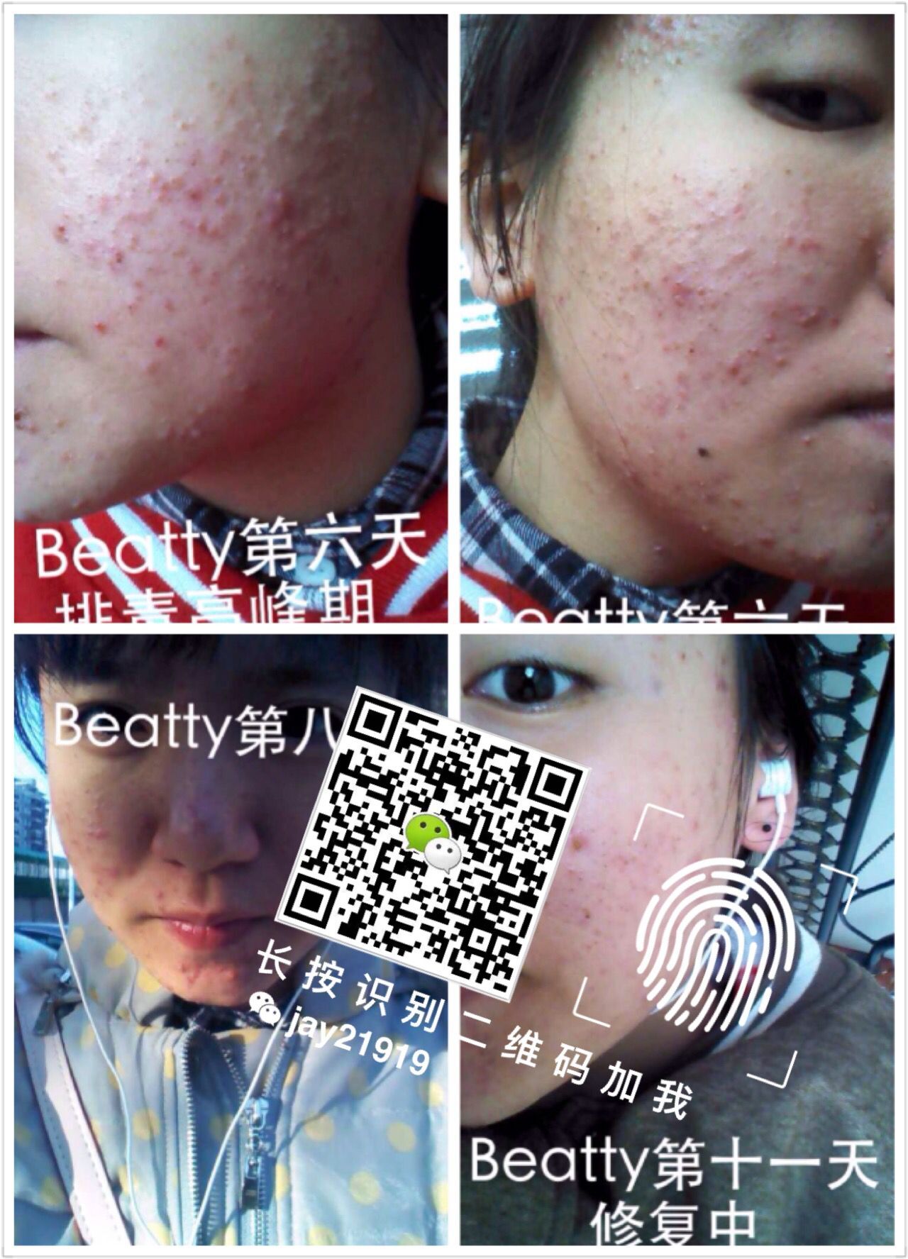 油性痘痘肌肤的清爽4步骤,2015最好用的祛痘产品推荐