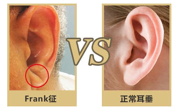 高以翔耳垂折痕是怎么回事?耳垂折痕的真实说法是猝死前兆?