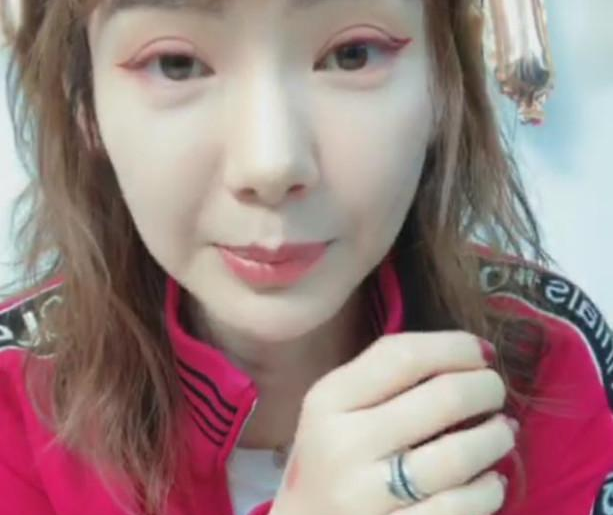 戚薇的双眼皮是不是割的前后宽太大了吧 戚薇肉条双眼皮前后照片