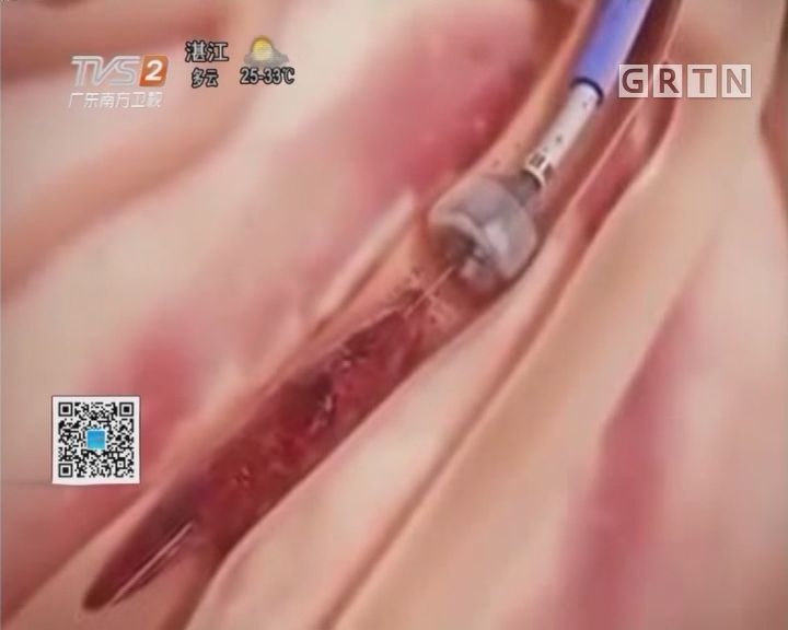 只有1mm的血管潜水艇放大好神奇呀!居然能做这些事研制成功了吗?