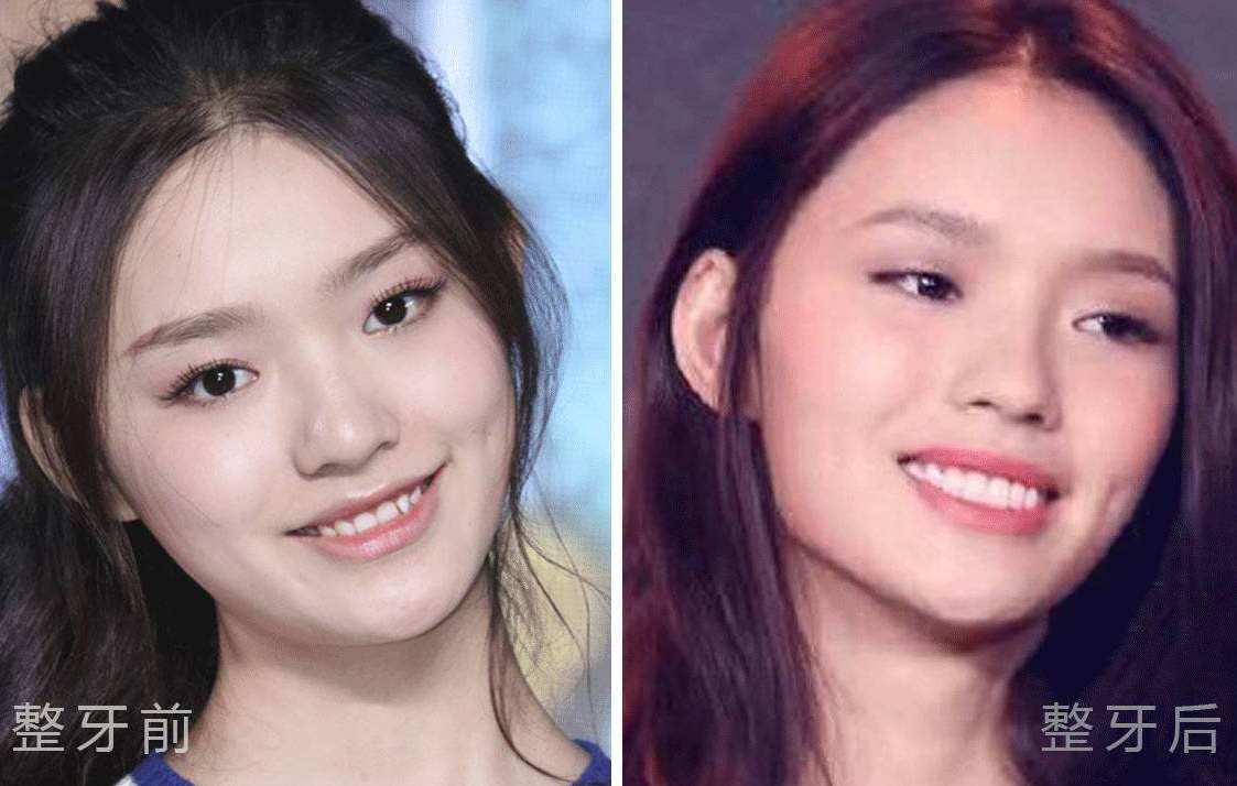 林允脸型变化了吗